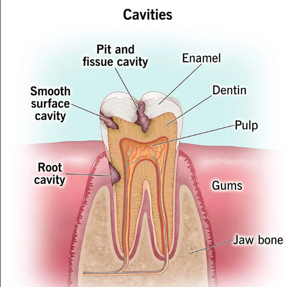 Cavities Care